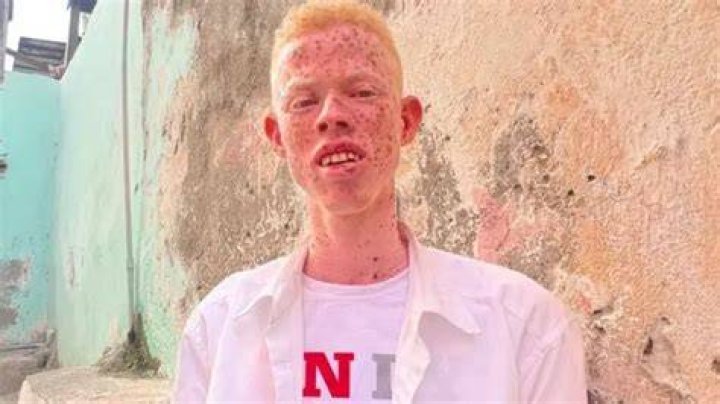 Are albinos considered disabled?