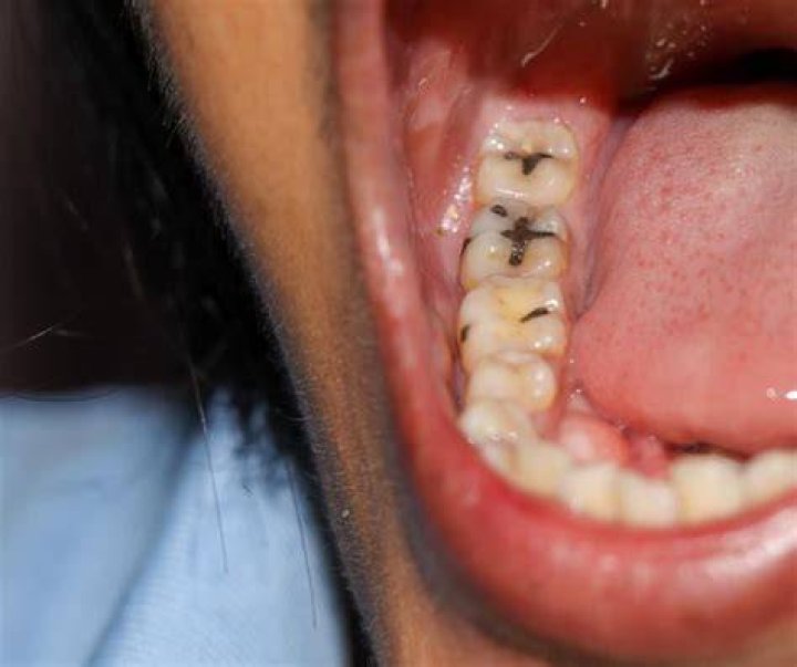 Are cavities common?