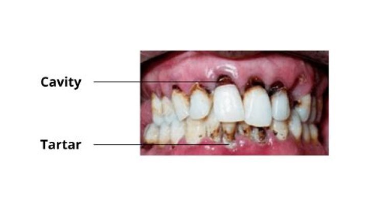 Are cavities fatal?