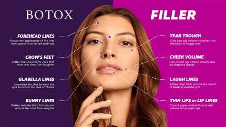 Are fillers Better than Botox?