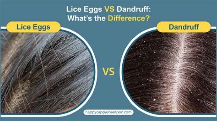 Are lice nits hard or soft?