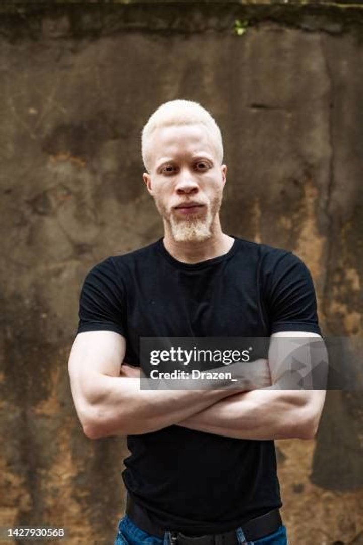 Are there any famous albinos?