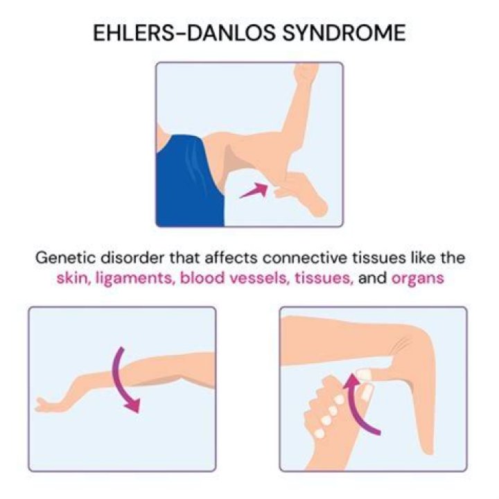 At what age is Ehlers-Danlos syndrome diagnosed?