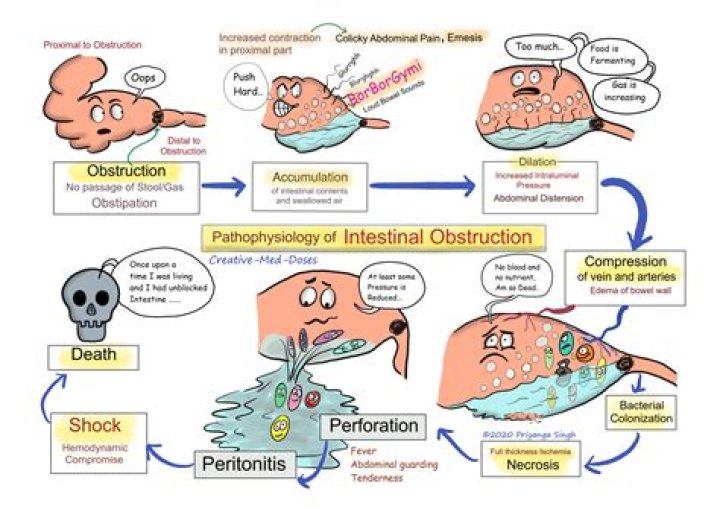 Can a bowel blockage cause sepsis?