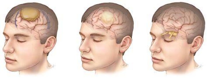 Can a brain tumor cause facial twitching?