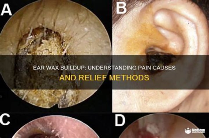 Can a doctor see ear wax build up?