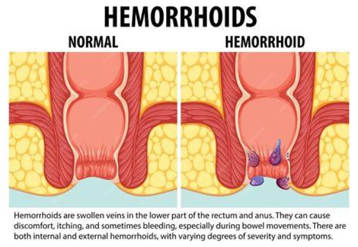 Can a hemorrhoid pop?
