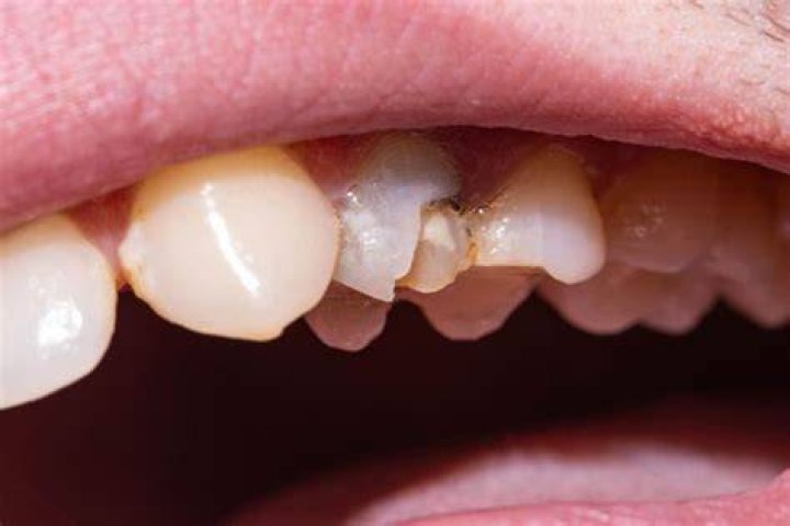 Can a rotting tooth be saved?