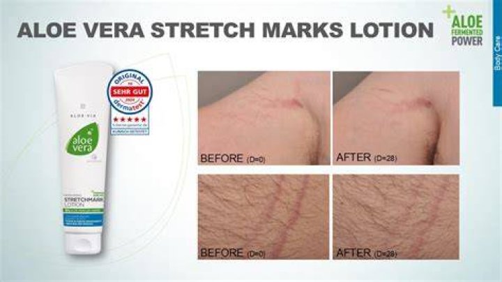 Can aloe vera clear stretch marks?