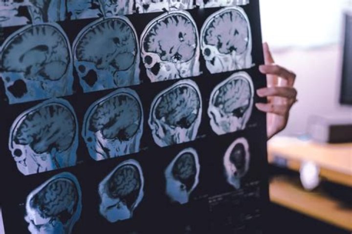 Can benzodiazepines cause dementia?