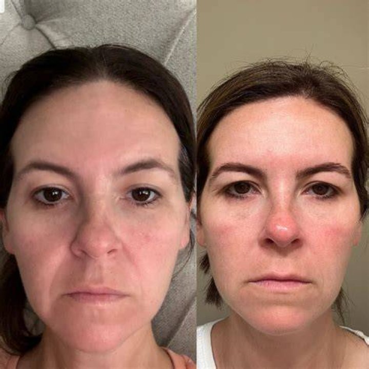 Can Botox lift hooded eyes?