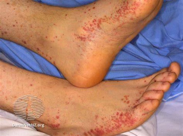 Can Covid bring on vasculitis?