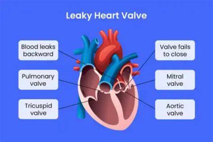Can CT scan show leaky heart valve?