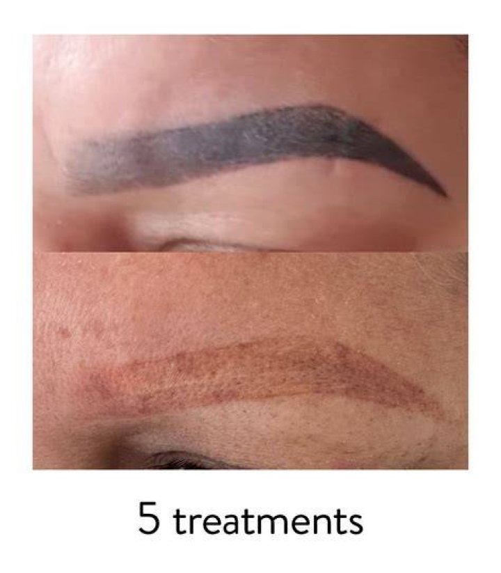 Can eyebrow tattoo be removed?