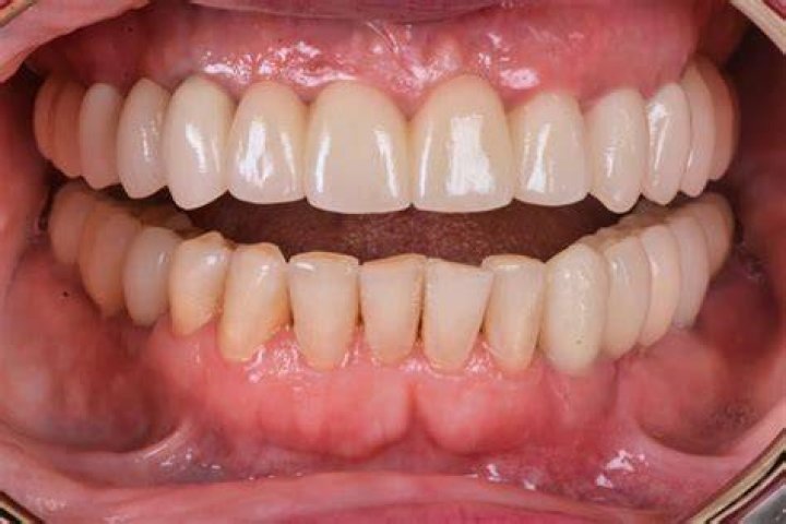 Can gum pockets grow back?