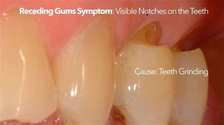 Can gums temporarily recede?
