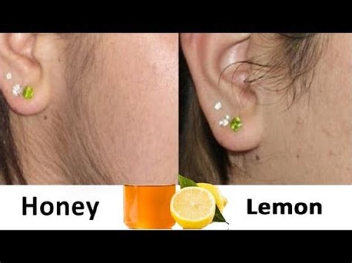 Can honey and lemon remove facial hair?