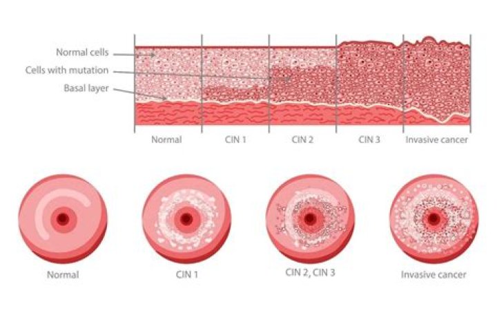 Can HPV come back after hysterectomy?