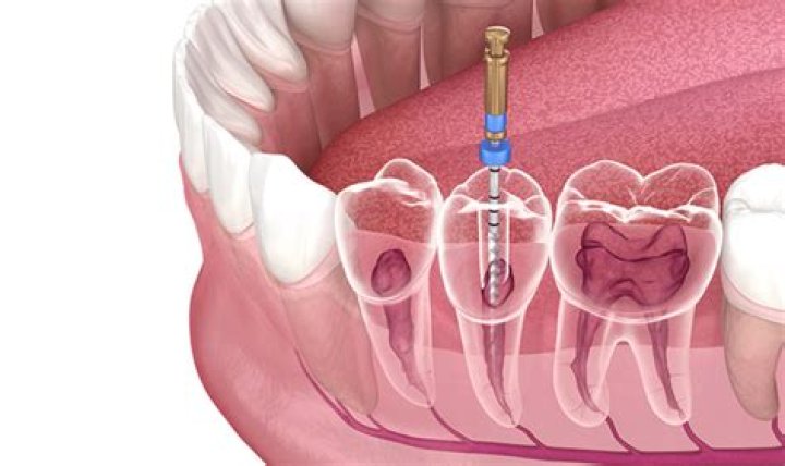 Can I brush my teeth after root canal with temporary filling?