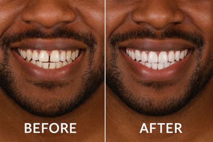 Can I floss with veneers?