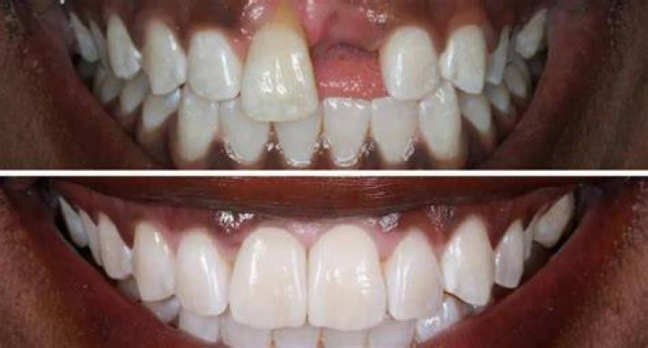 Can I get veneers if I have missing teeth?