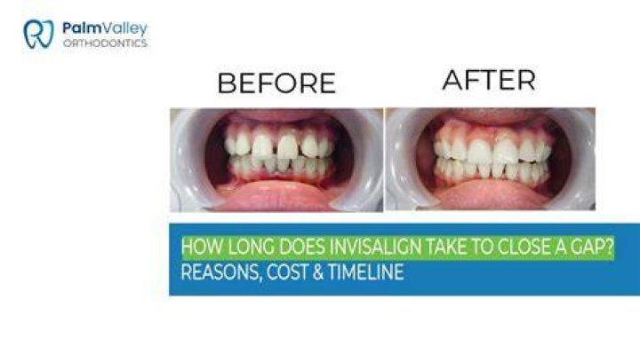Can I leave my Invisalign out for 2 hours?