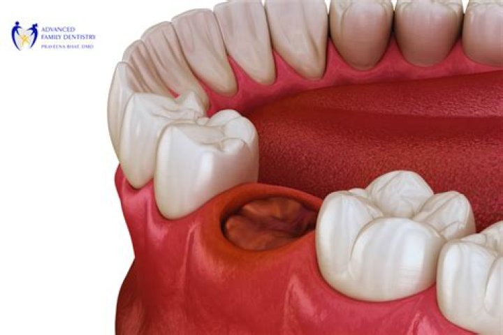 Can I swallow after tooth extraction?