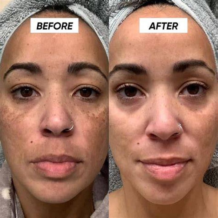 Can I use tretinoin for dark circles?