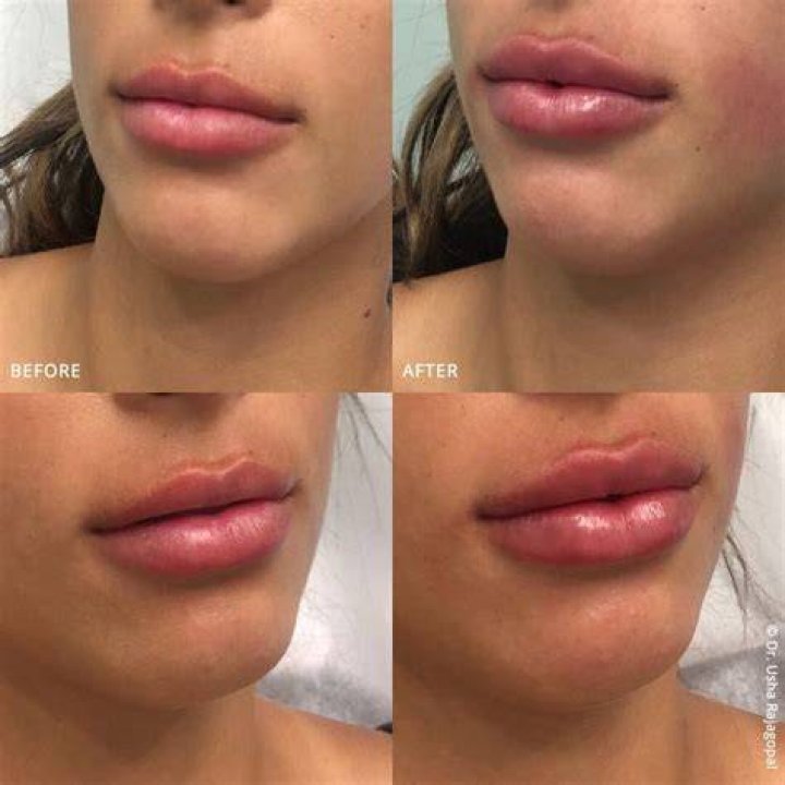 Can lip lift be done with fillers?