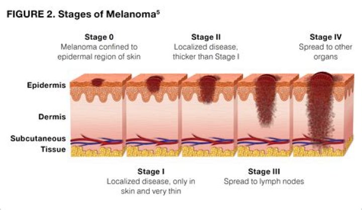 Can melanoma cause lower back pain?