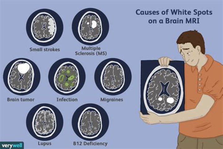 Can migraines cause white matter lesions?