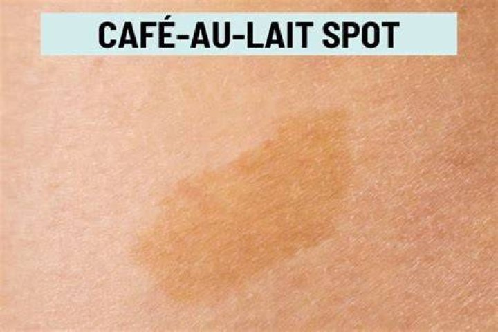 Can multiple café-au-lait spots be normal?
