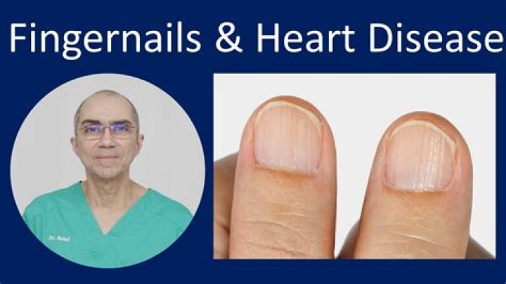 Can nails show heart problems?