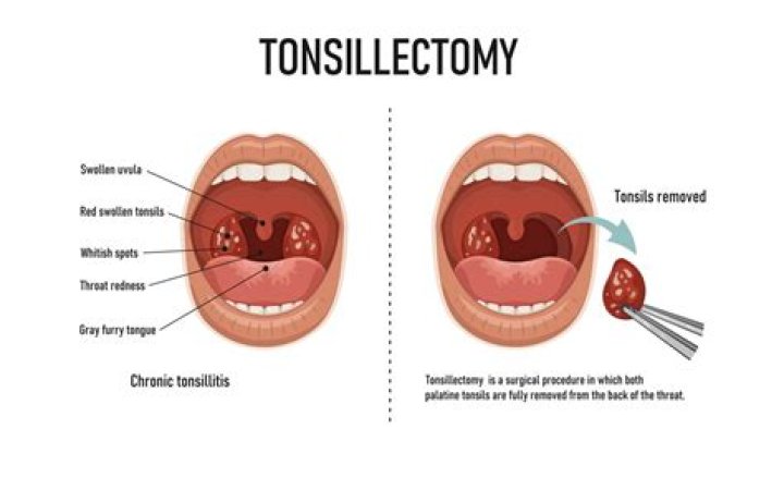 Can removing tonsils cause weightloss?