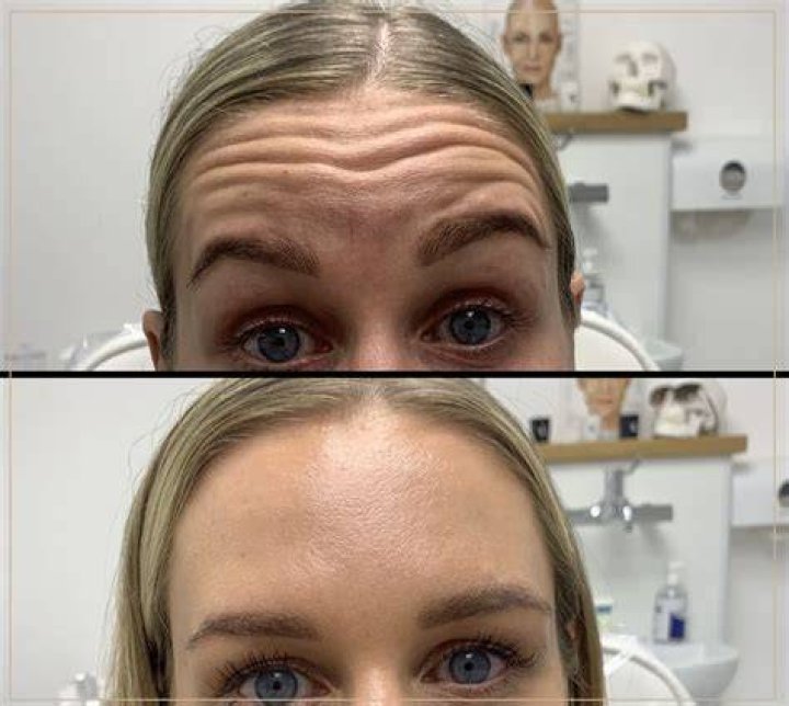 Can retinol make your wrinkles worse?