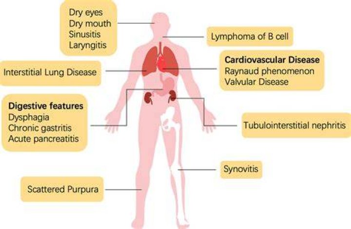 Can sjogrens affect your stomach?