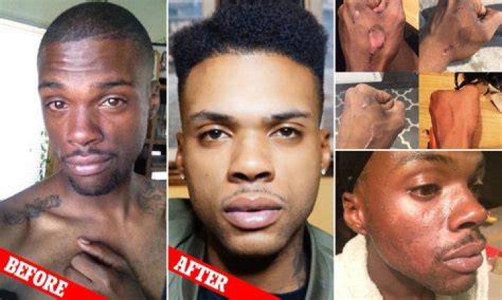 Can skin be bleached?