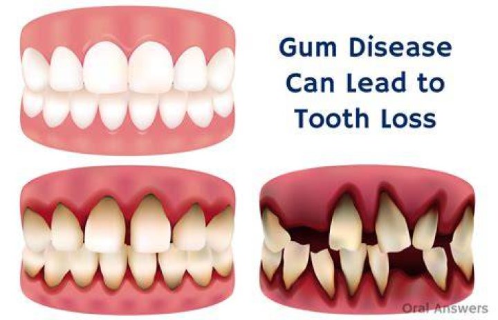 Can stress cause you to lose your teeth?