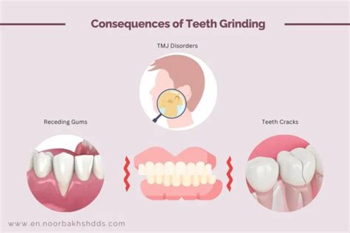Can teeth grinding cause double chin?