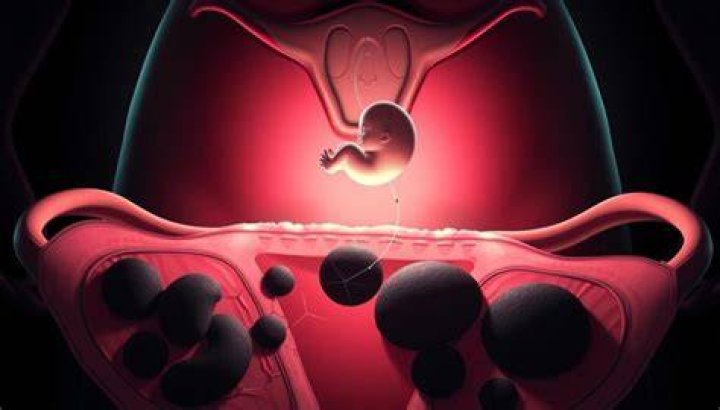 Can you bleed to death from fibroids?