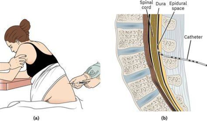 Can you breastfeed after epidural?