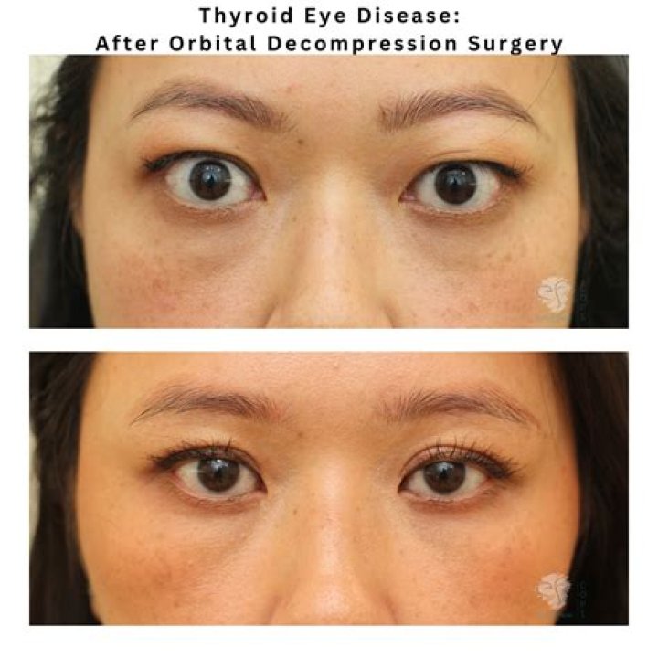 Can you develop hypothyroidism after surgery?