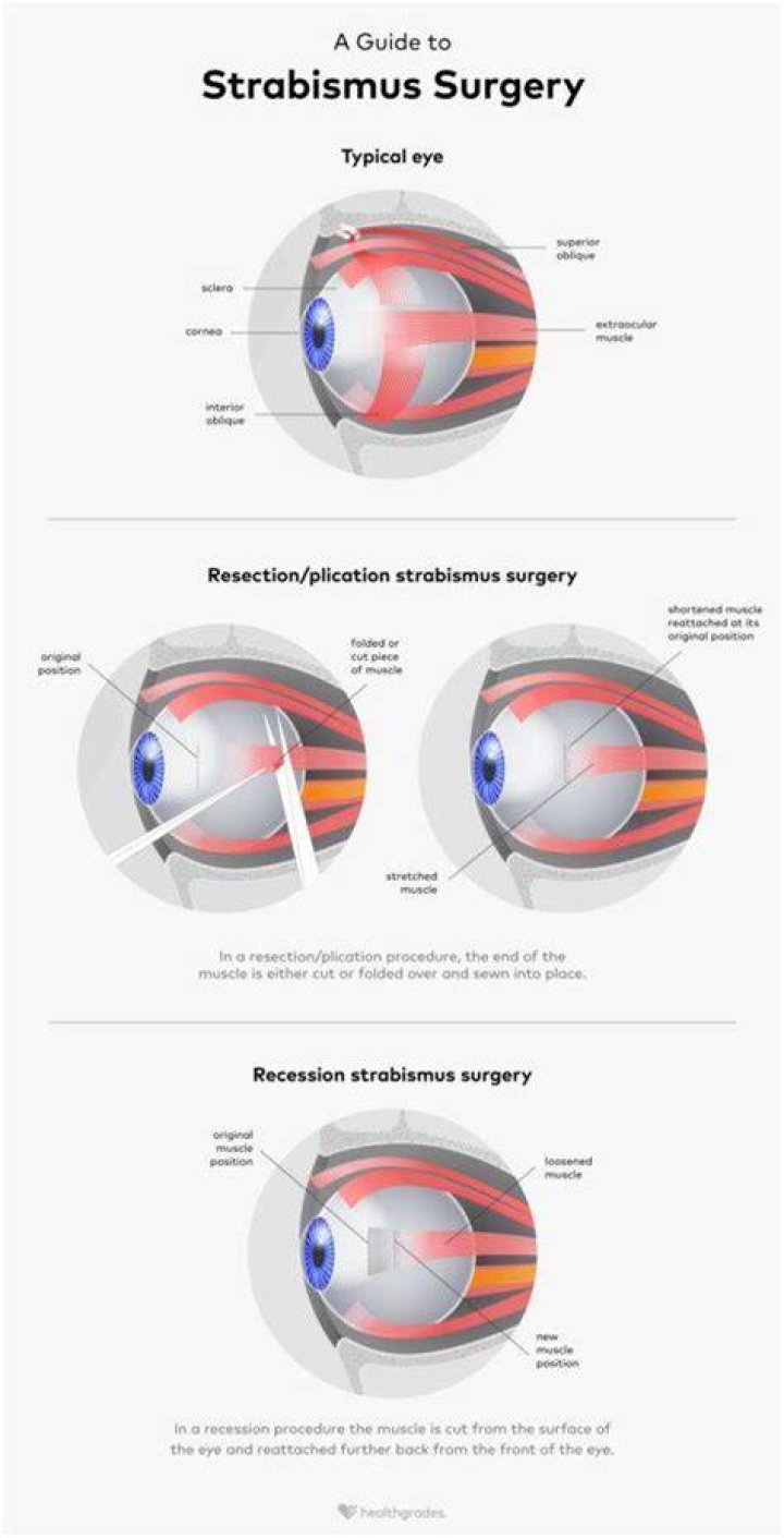 Can you drink alcohol after strabismus surgery?
