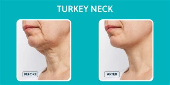 Can you get rid of a turkey neck?