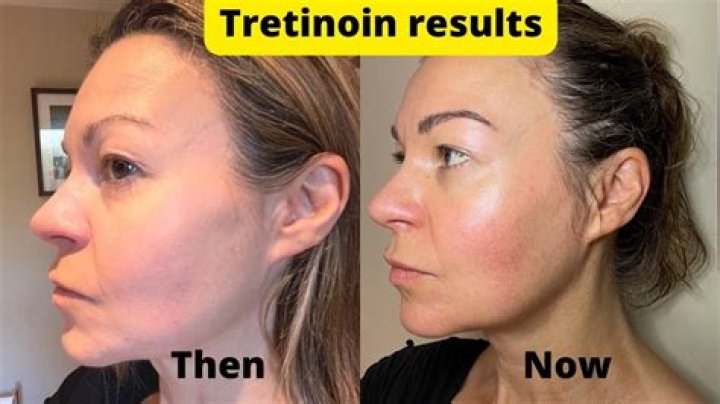 Can you put retinol on your neck?