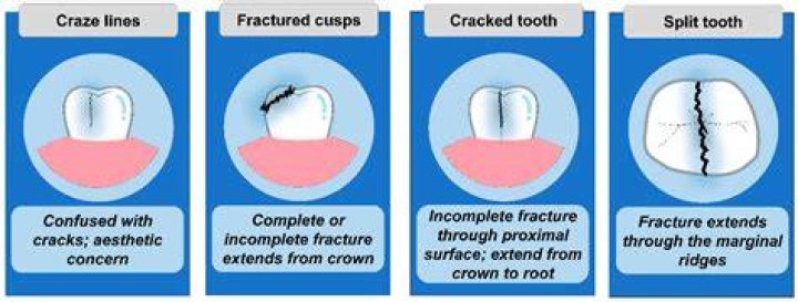 Can you seal a cracked tooth?