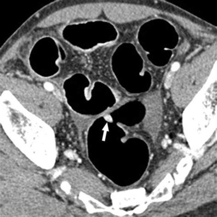 Can you see colon polyps on an ultrasound?