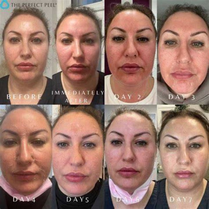 Can you see results after 1 peel?