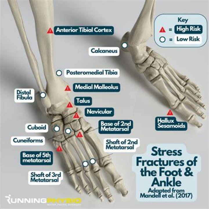 Can you walk on a fractured foot?