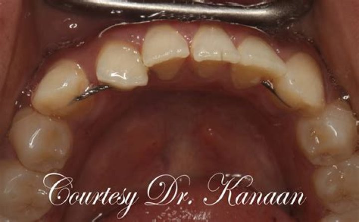 Can your teeth still shift with permanent retainers?